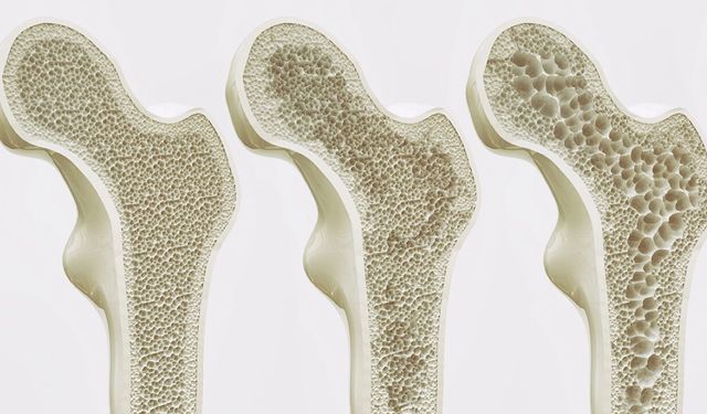 KEMİK ERİMESİNE HANGİ BESİNLER İYİ GELİR?